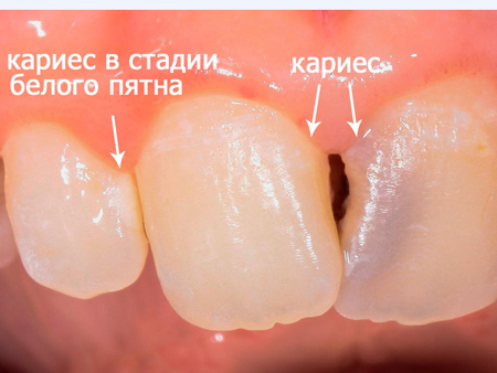 кариес на передних зубах